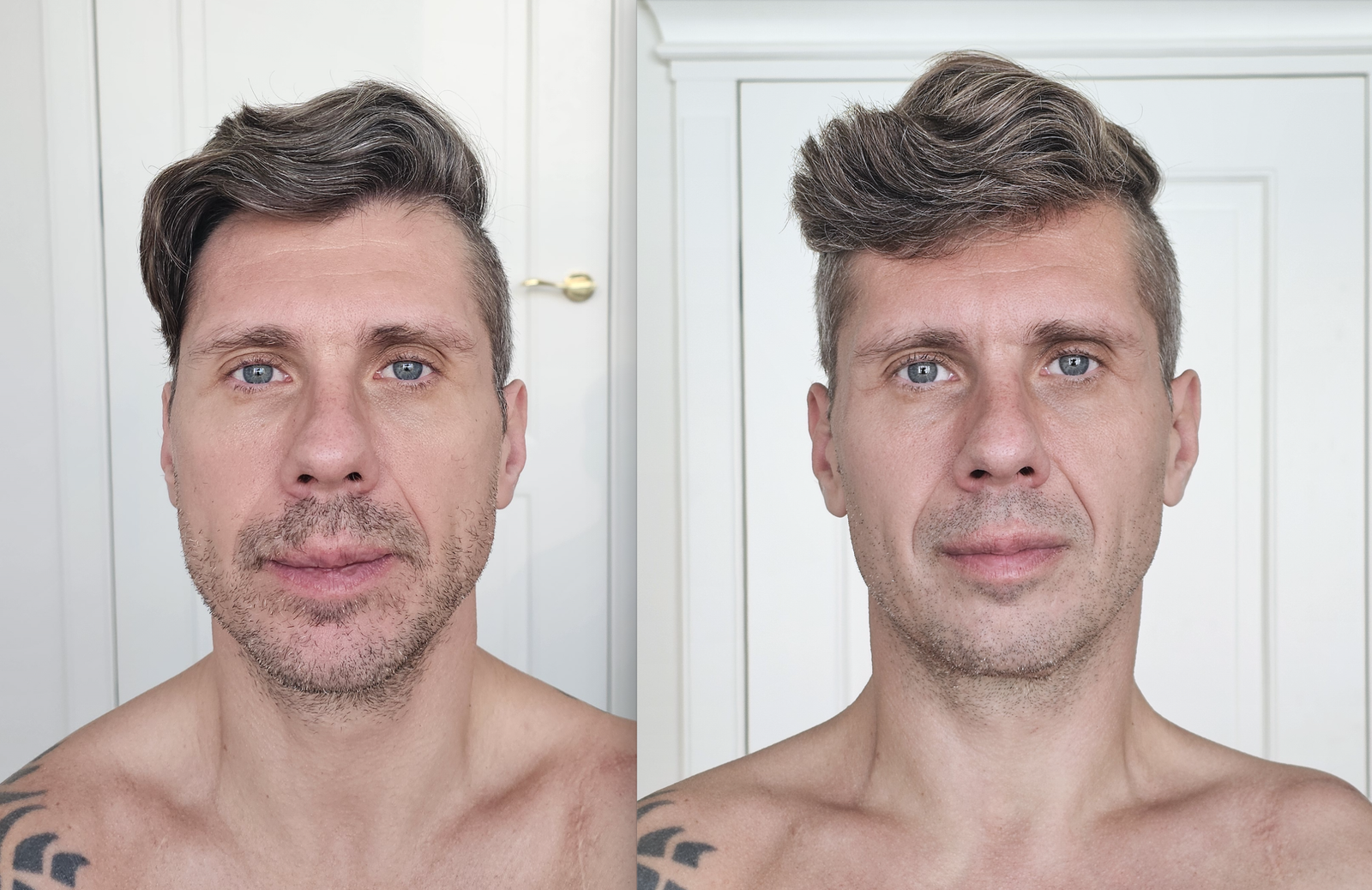 Michał przed i po 6 miesiącach Fascial Maneuvers